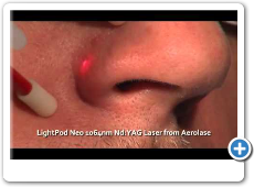 Facial Vessel Removal With LightPod Neo 1064nm Laser from Aerolase