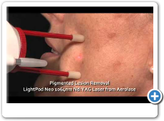 Pigmented lesion and sun & age spot removal with the LightPod Neo 1064nm laser from Aerolase